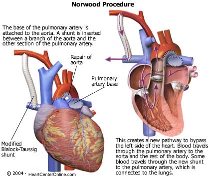 Norwood Sano Procedure