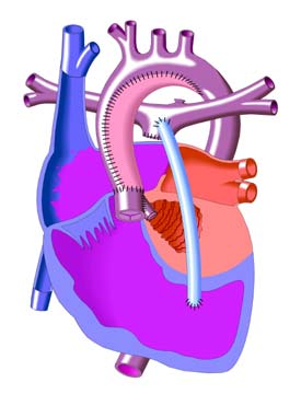 Norwood Sano Procedure